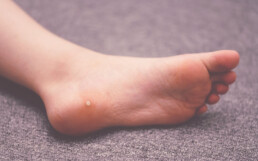Verrucae Treatment - The Healthy Foot Clinic New Ollerton Newark